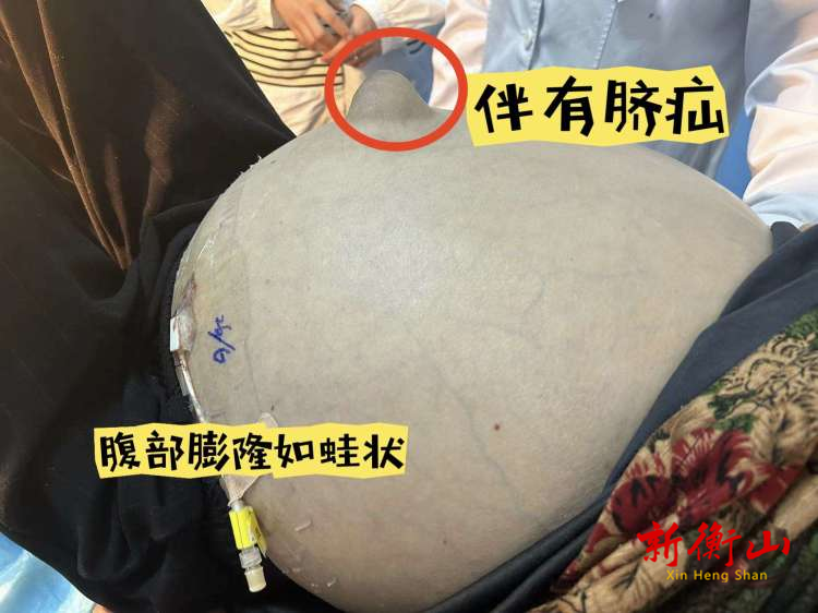 72岁老奶奶肚如9月孕妇，南华医院多学科联动解难题