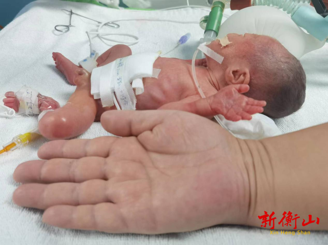巴掌大的宝宝康复出院啦！ 26周900克超早产儿在南华医院救治成功！