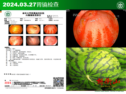 南华医院多学科联合成功诊治罕见“西瓜胃”，创造多个医学“第一”